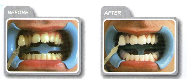 Teeth whitening